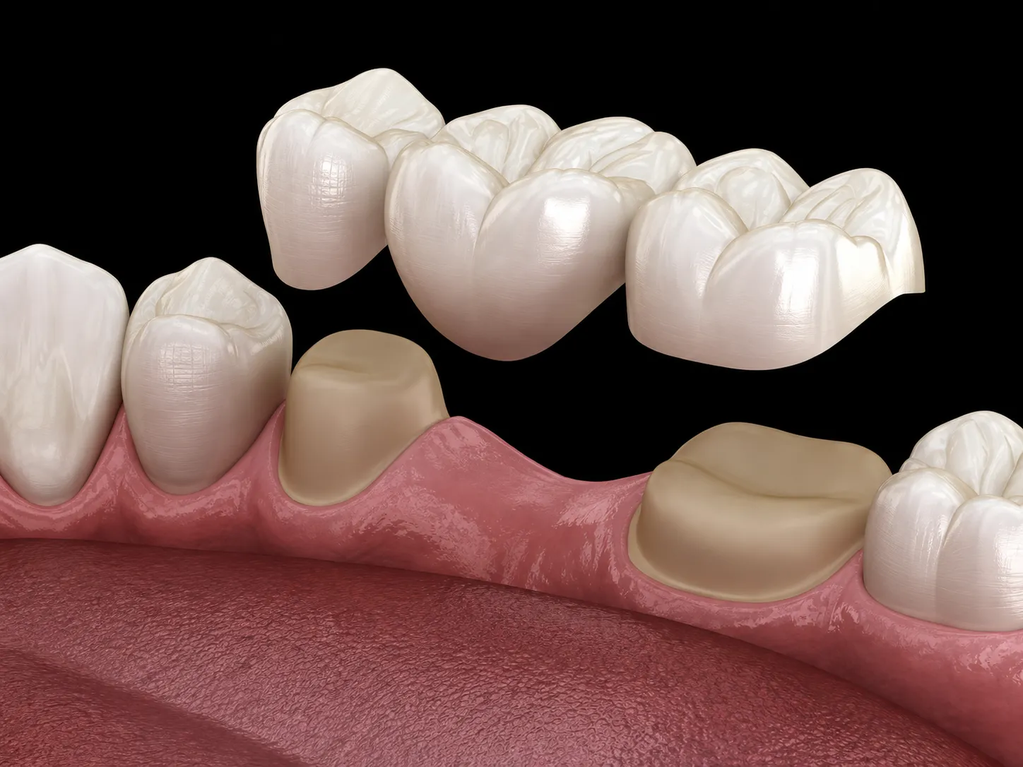 I WANT TO RESTORE MY TEETH